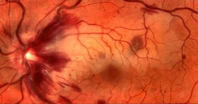 vaisseaux sanguins rétiniens et restauration de la vision